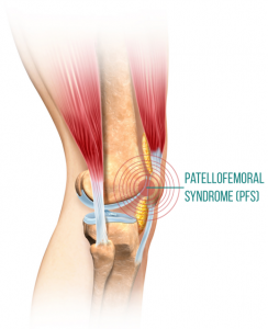 pfs_front_knee_pain