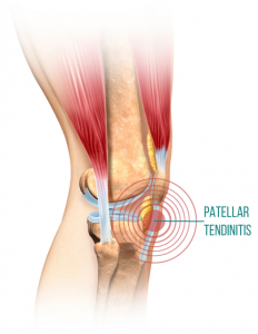 Patellar_Tendinitis_front_knee_pain