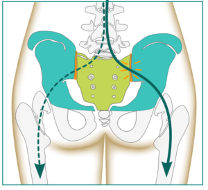 lower back pain in women